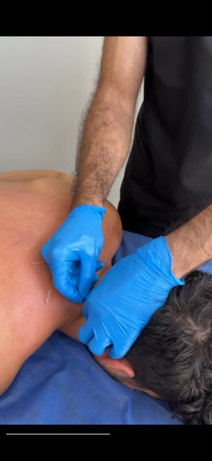 Dry needling for the shoulder and neck muscles at Oriana Clinic
