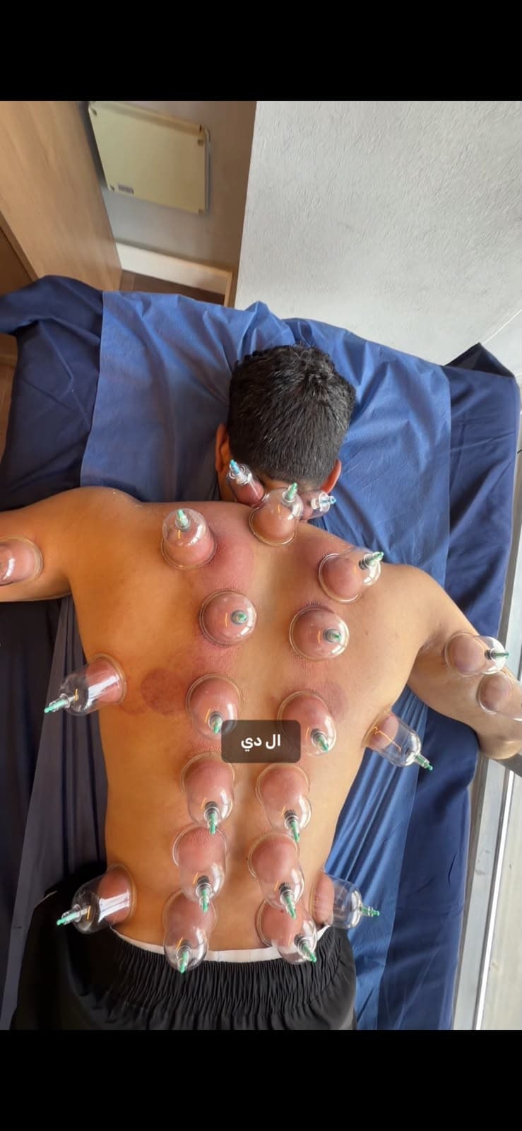 A therapeutic cupping session at Oriana Clinic